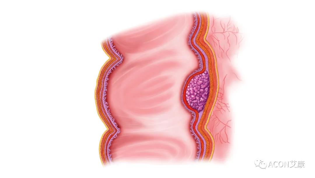 因?yàn)楹鲆暽眢w出現(xiàn)的這些變化，他們最后被確診結(jié)腸癌