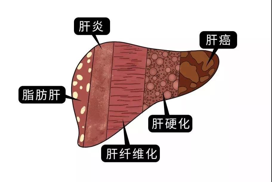 脂肪肝的最大敵人不是肥胖，答案竟是這樣！