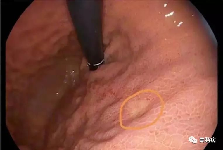 醫(yī)生總結(jié)了3位年輕胃癌患者的病例：30歲不到的他們到底干啥了？