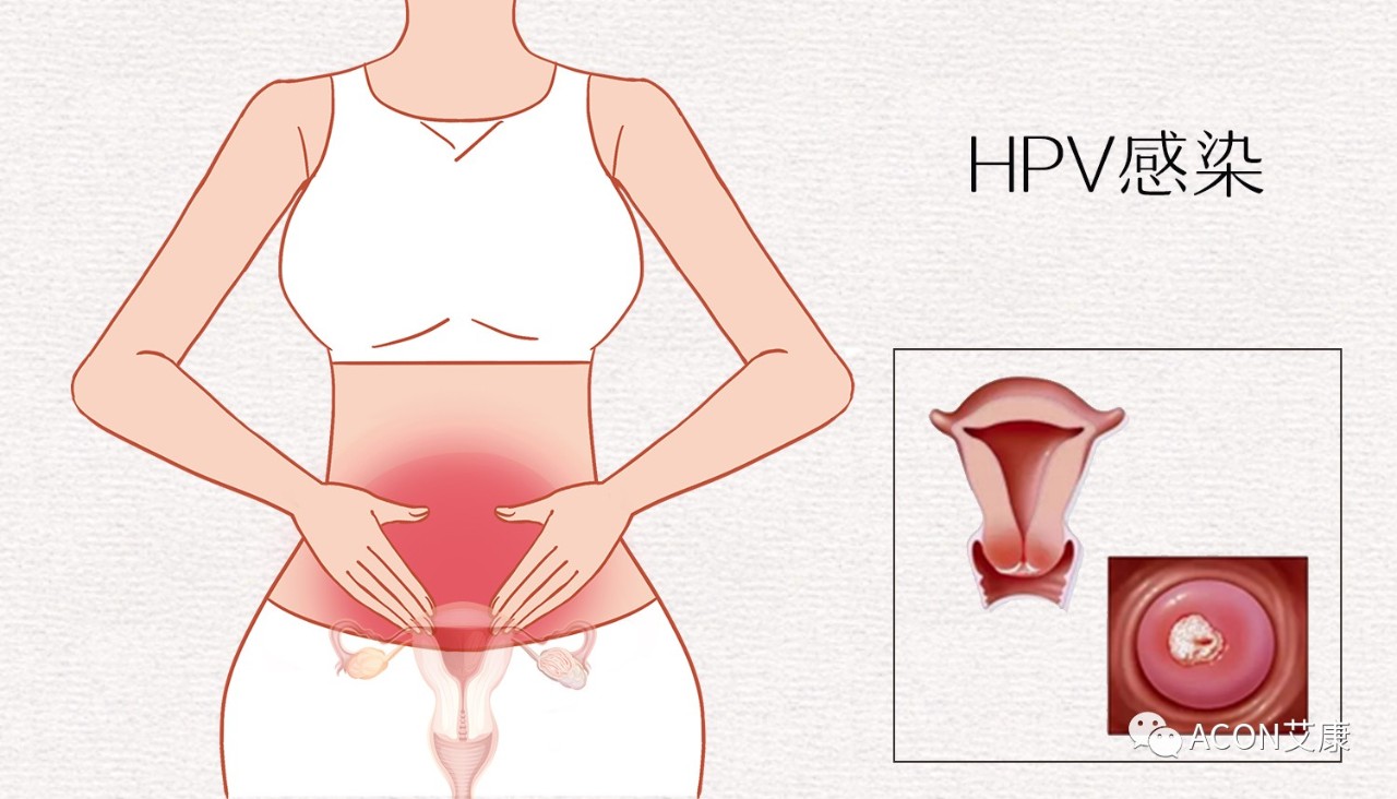HPV轉(zhuǎn)陰其實很簡單， 女性必知的宮頸癌真相