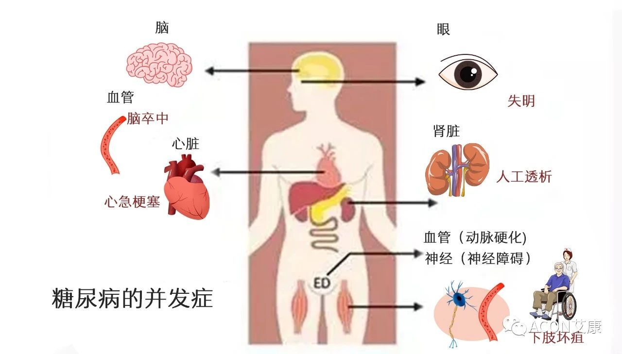 爆上熱搜，因爆發(fā)型糖尿病進入ICU，有哪些教訓(xùn)值得我們汲取