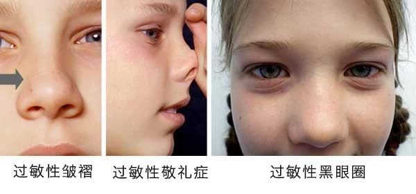 過(guò)敏性鼻炎會(huì)讓孩子變傻？！家長(zhǎng)該如何應(yīng)對(duì)